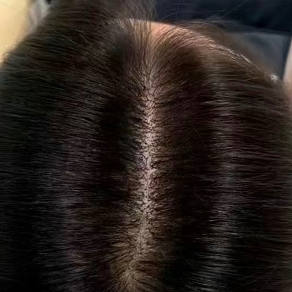女士髮界綫稀疏 療程後