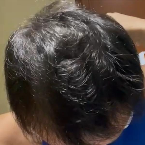 男性雄禿 療程後