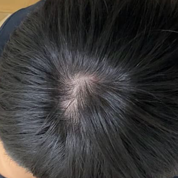 斑禿困擾 療程後