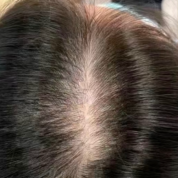 女士髮界綫稀疏 療程前