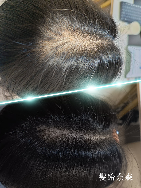 林女士 療程前後對比